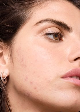 existe-una-relacion-entre-los-productos-lacteos-y-el-acne