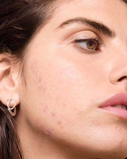 existe-una-relacion-entre-los-productos-lacteos-y-el-acne
