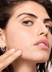 que-es-el-acne-hormonal-y-como-una-rutina-de-cuidado-de-la-piel-puede-ayudar