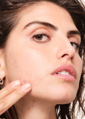 pueden-los-alimentos-causar-acne