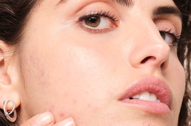 pueden-los-alimentos-causar-acne